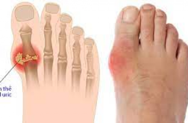 Tác dụng của đông trùng hạ thảo với bệnh gout